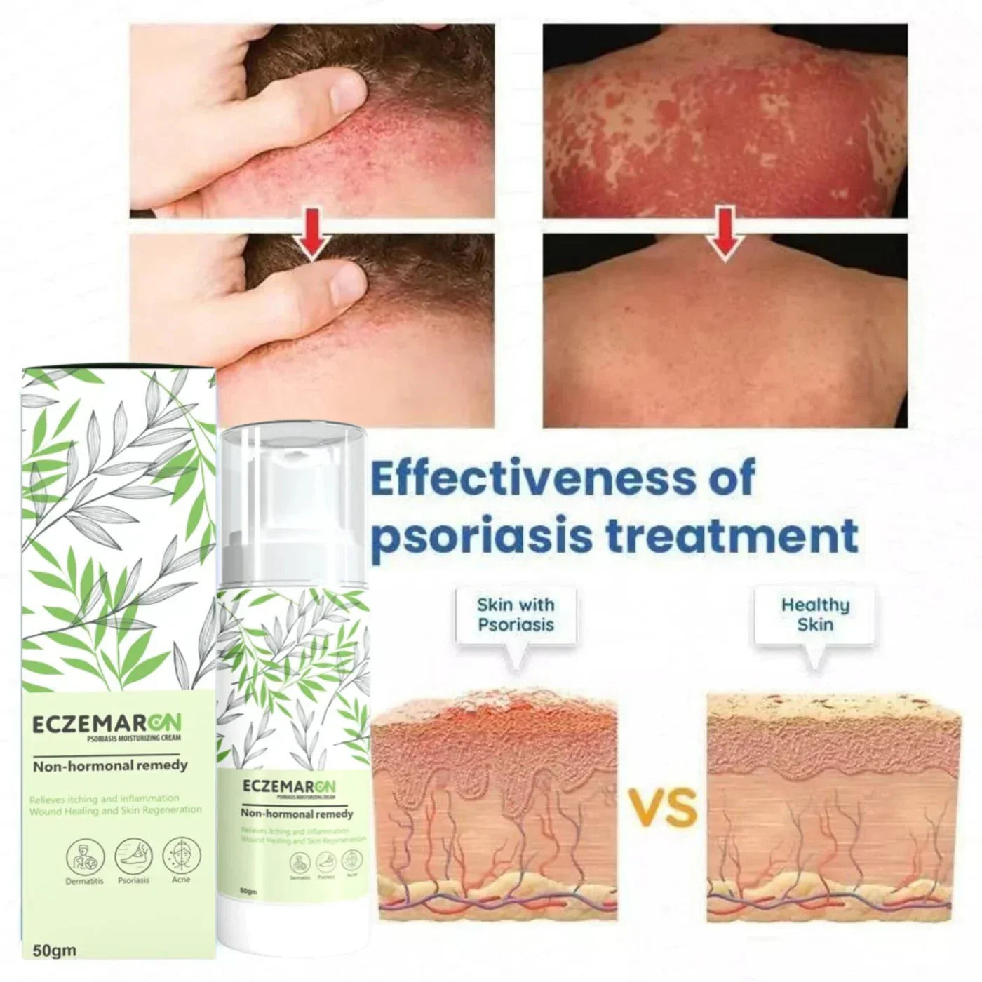 Noviq™️ Eczemaron Anti Fungal Cream v Spray | Buy 1 Get 1 Free